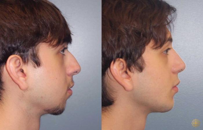 Before & After Rhinoplasty Case 109 Right Side View in Newport Beach, CA