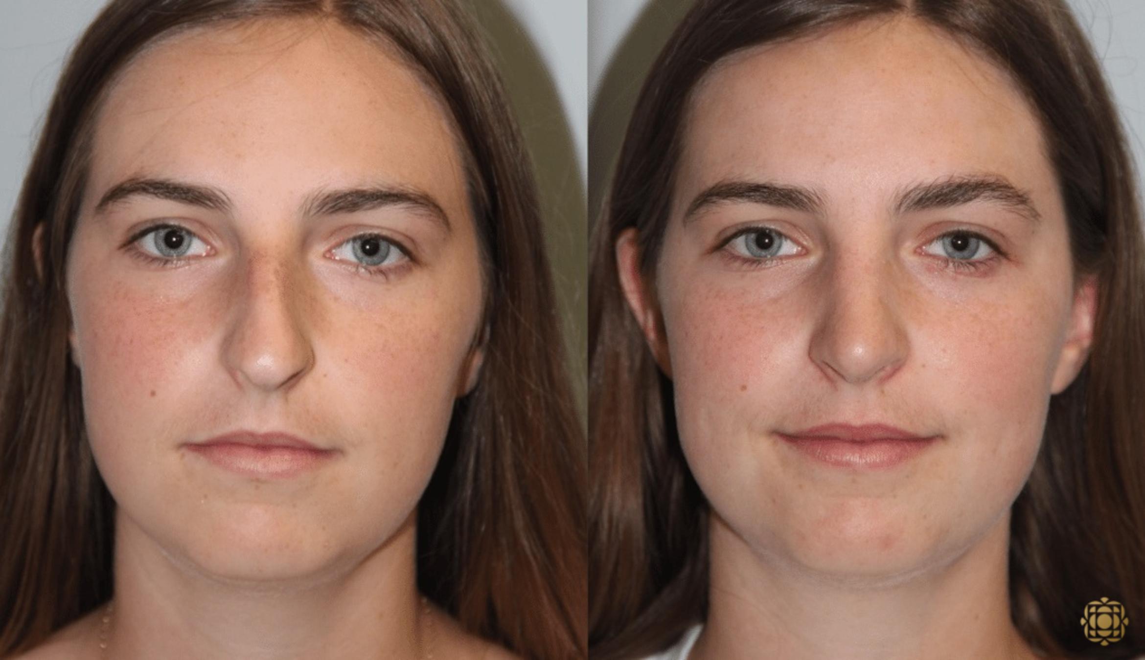 Before & After Rhinoplasty Case 110 View #1 View in Newport Beach, CA