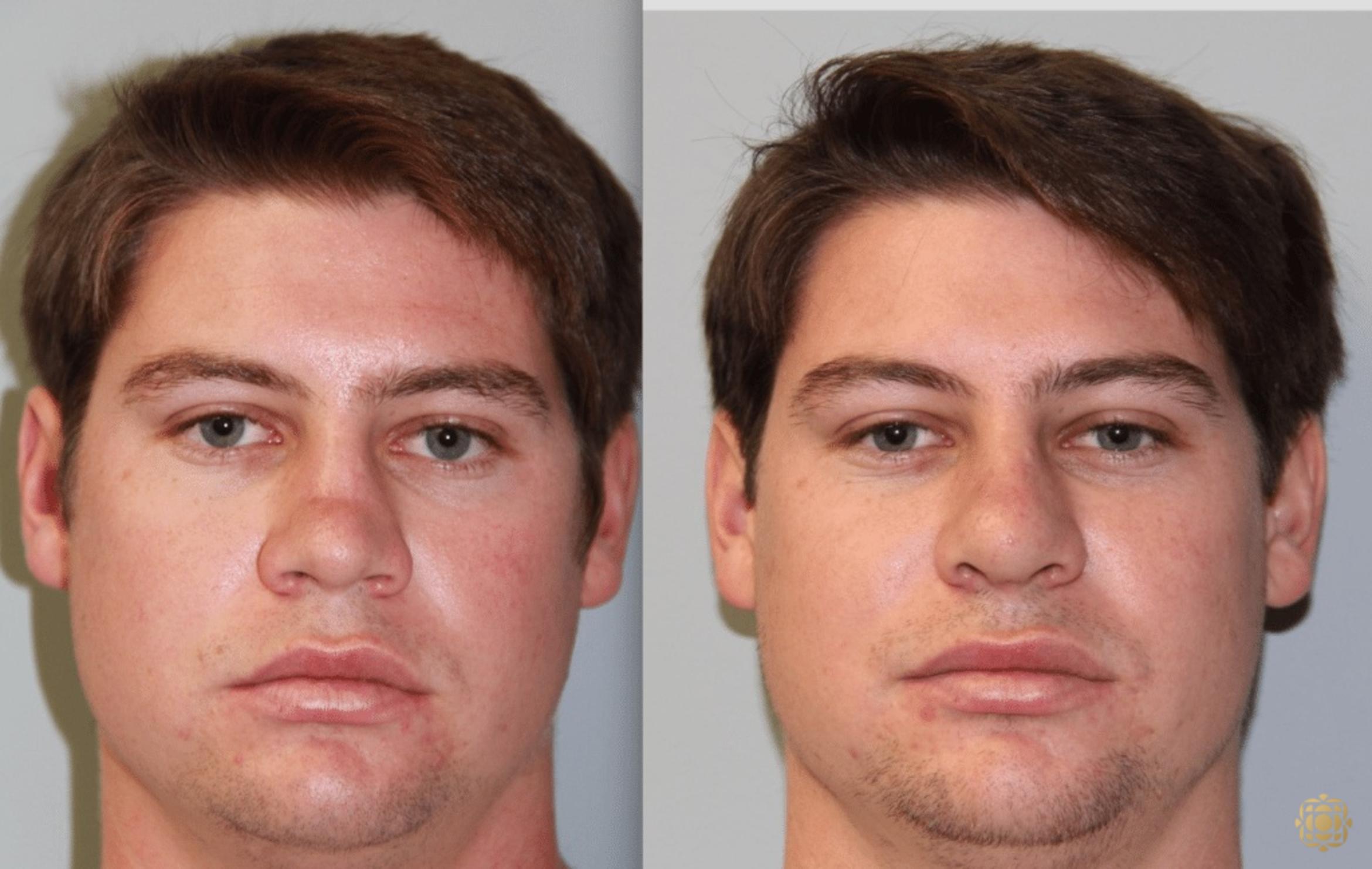 Before & After Rhinoplasty Case 113 View #1 View in Newport Beach, CA