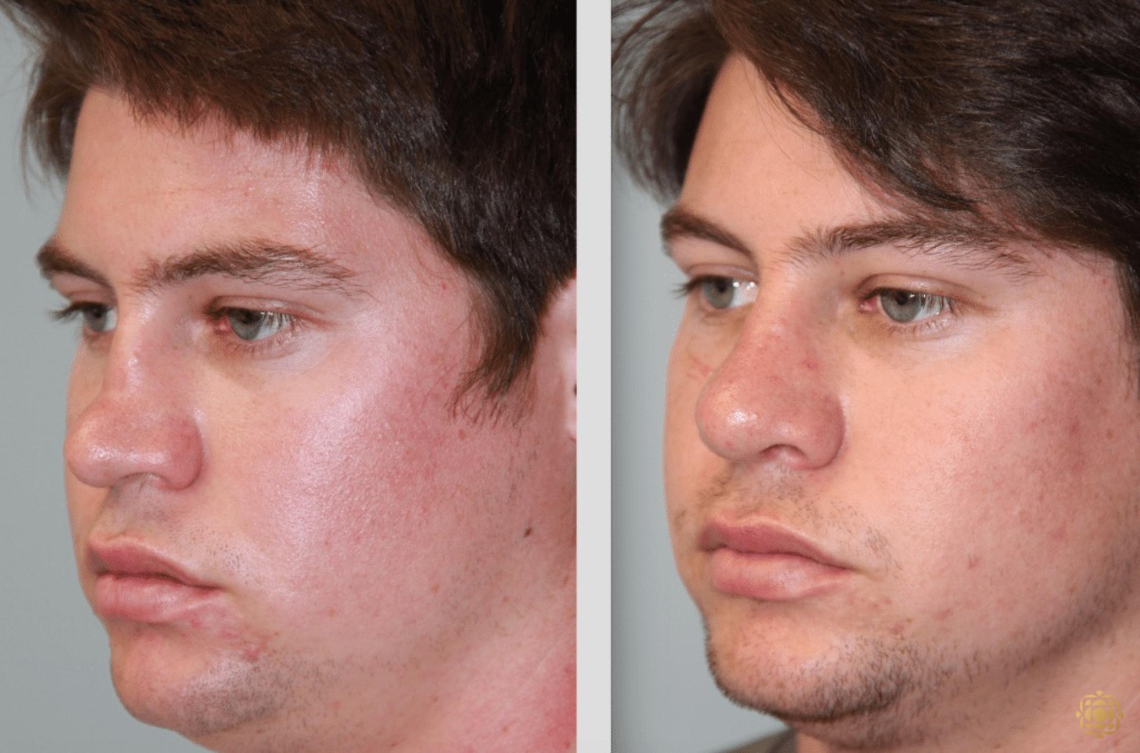 Before & After Rhinoplasty Case 113 View #2 View in Newport Beach, CA