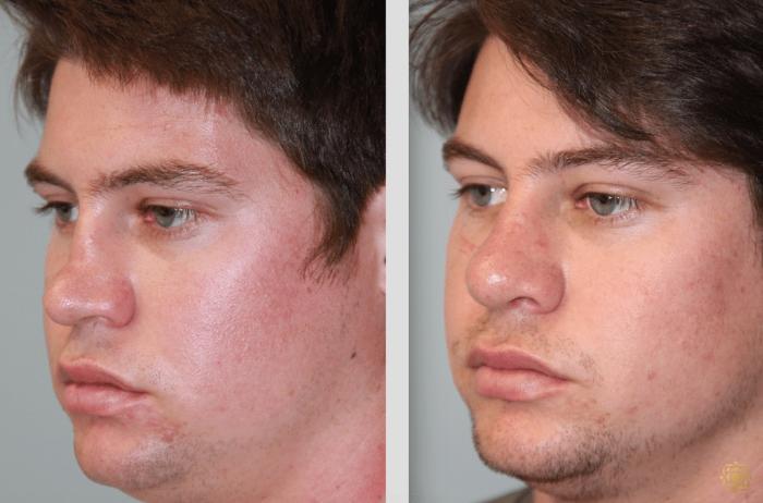 Before & After Rhinoplasty Case 113 View #2 View in Newport Beach, CA