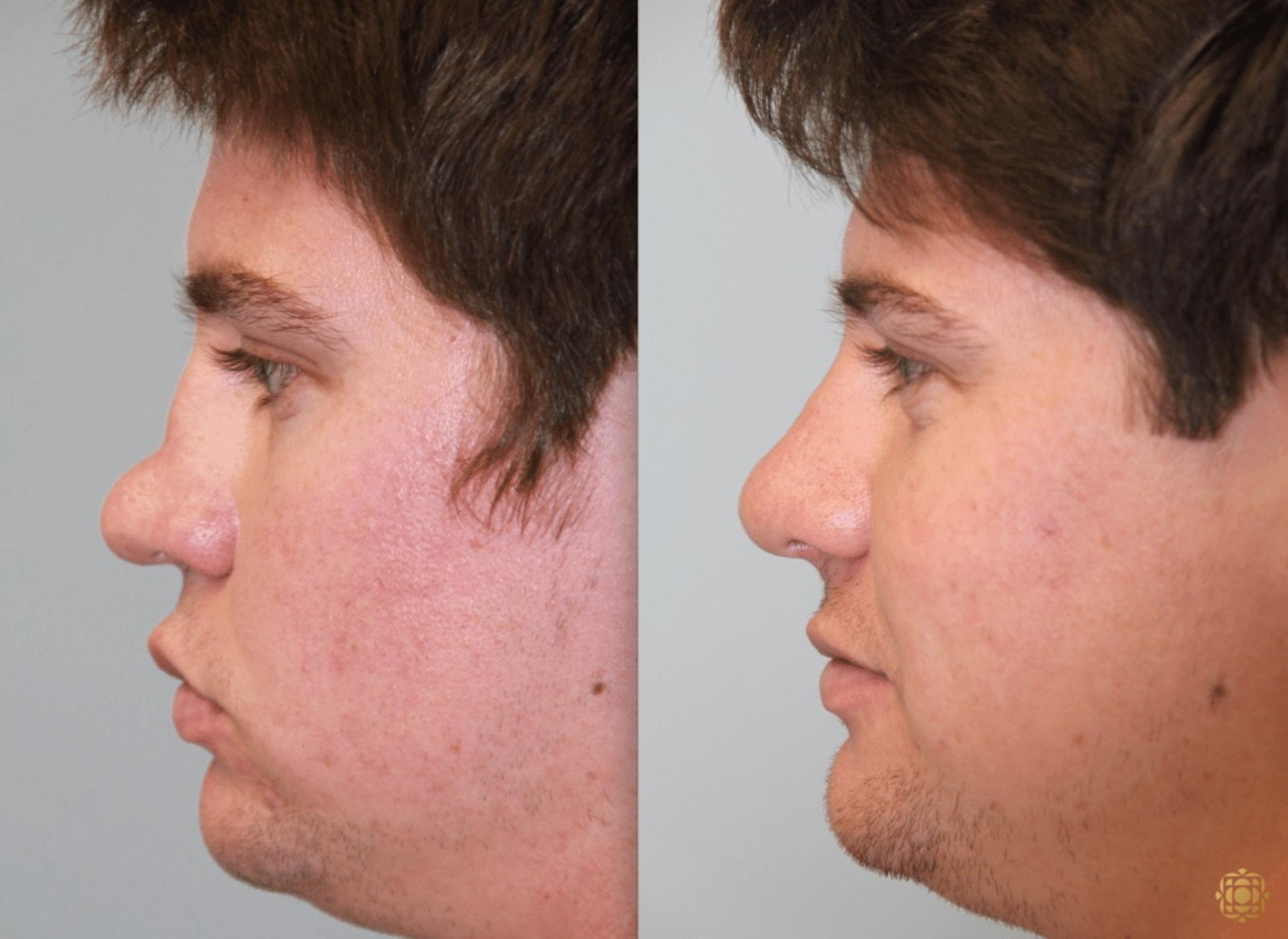 Before & After Rhinoplasty Case 113 View #3 View in Newport Beach, CA