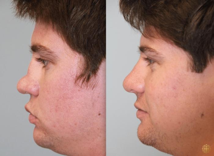 Before & After Rhinoplasty Case 113 View #3 View in Newport Beach, CA