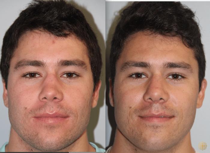 Before & After Rhinoplasty Case 114 View #1 View in Newport Beach, CA