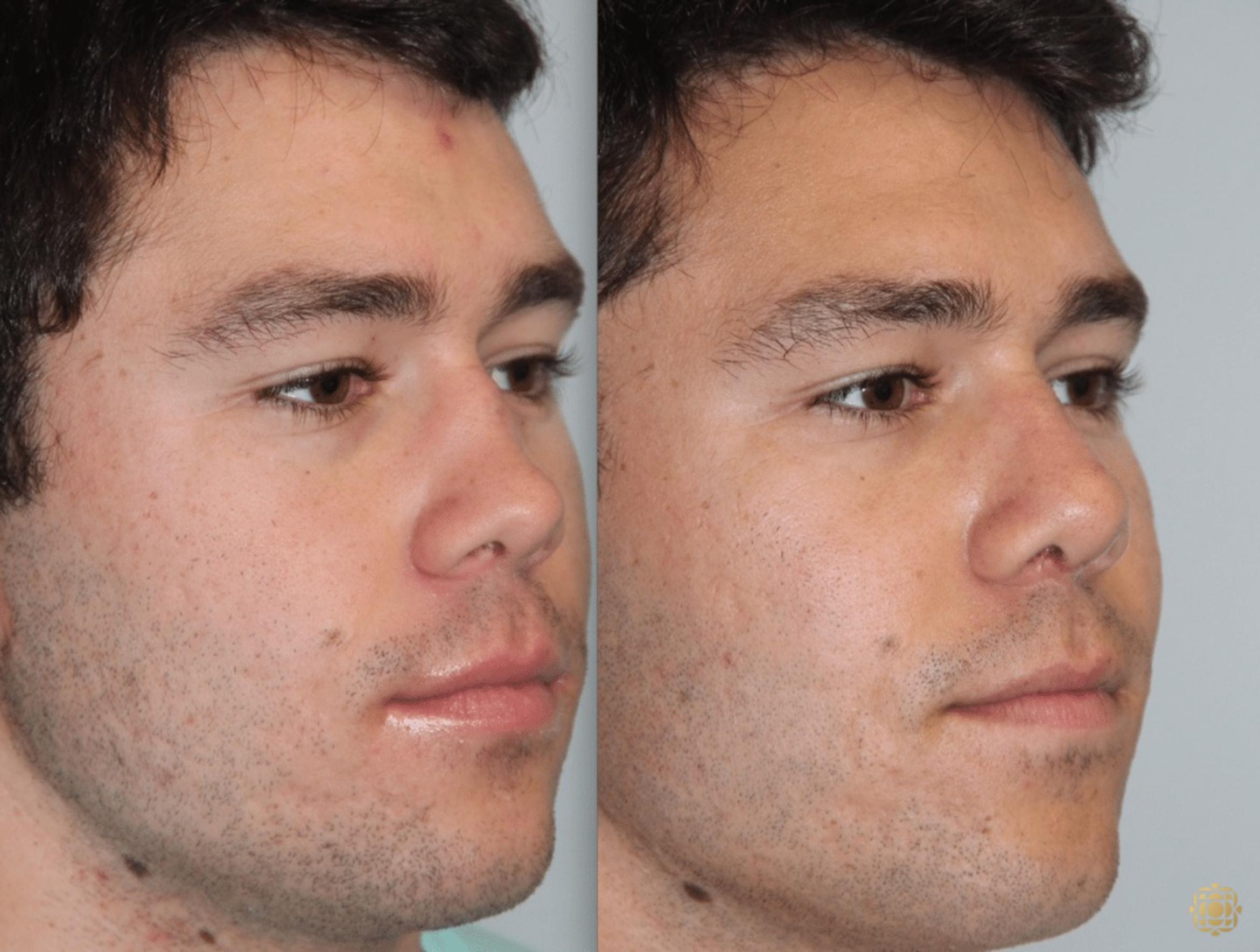 Before & After Rhinoplasty Case 114 View #2 View in Newport Beach, CA