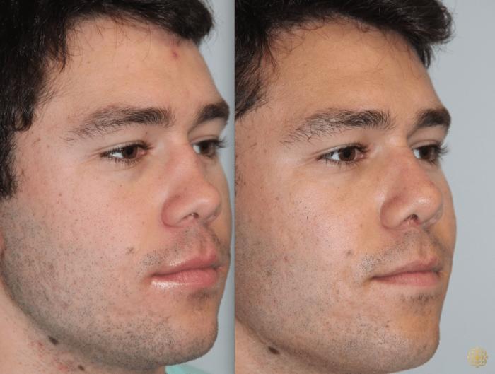 Before & After Rhinoplasty Case 114 View #2 View in Newport Beach, CA