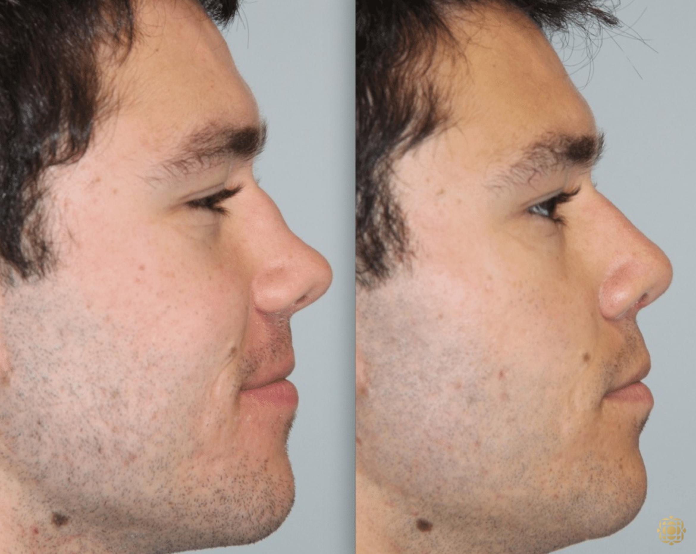 Before & After Rhinoplasty Case 114 View #3 View in Newport Beach, CA