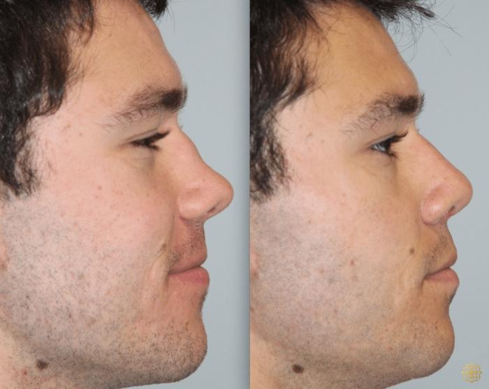 Before & After Rhinoplasty Case 114 View #3 View in Newport Beach, CA