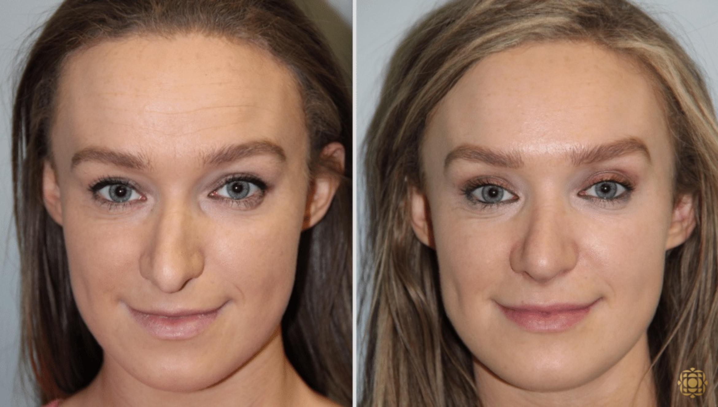 Before & After Rhinoplasty Case 117 View #1 View in Newport Beach, CA