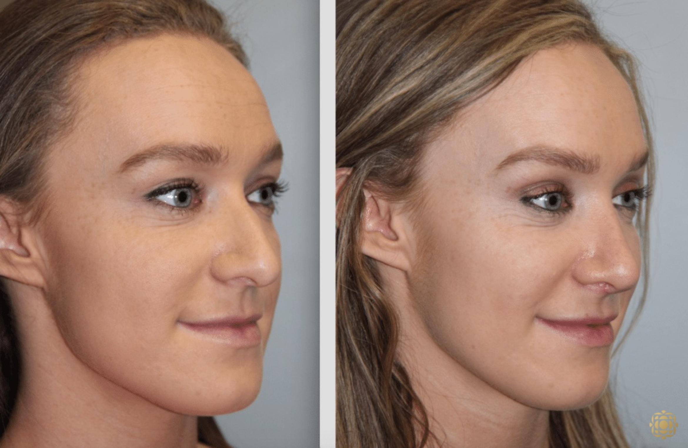 Before & After Rhinoplasty Case 117 View #2 View in Newport Beach, CA