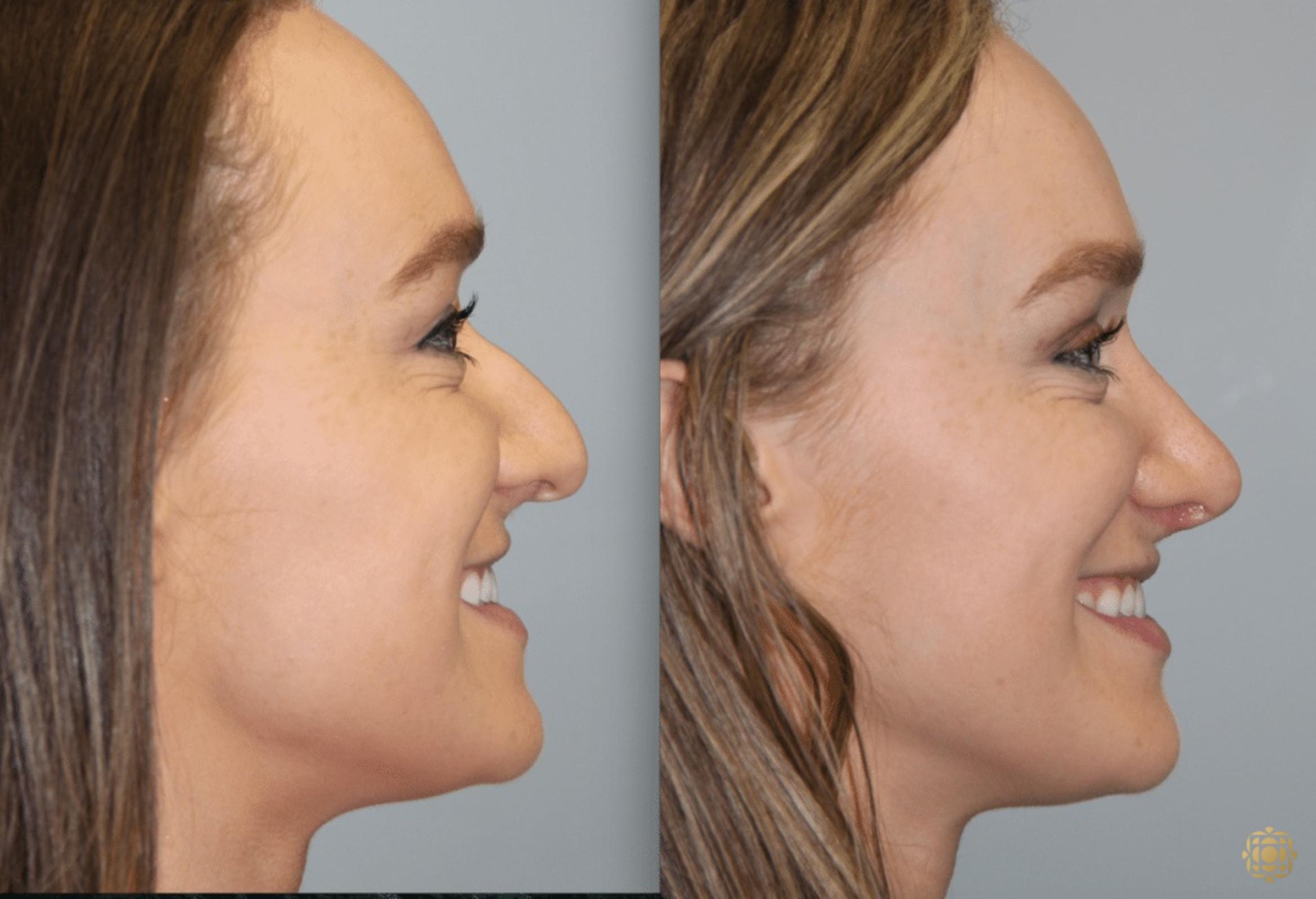 Before & After Rhinoplasty Case 117 View #3 View in Newport Beach, CA
