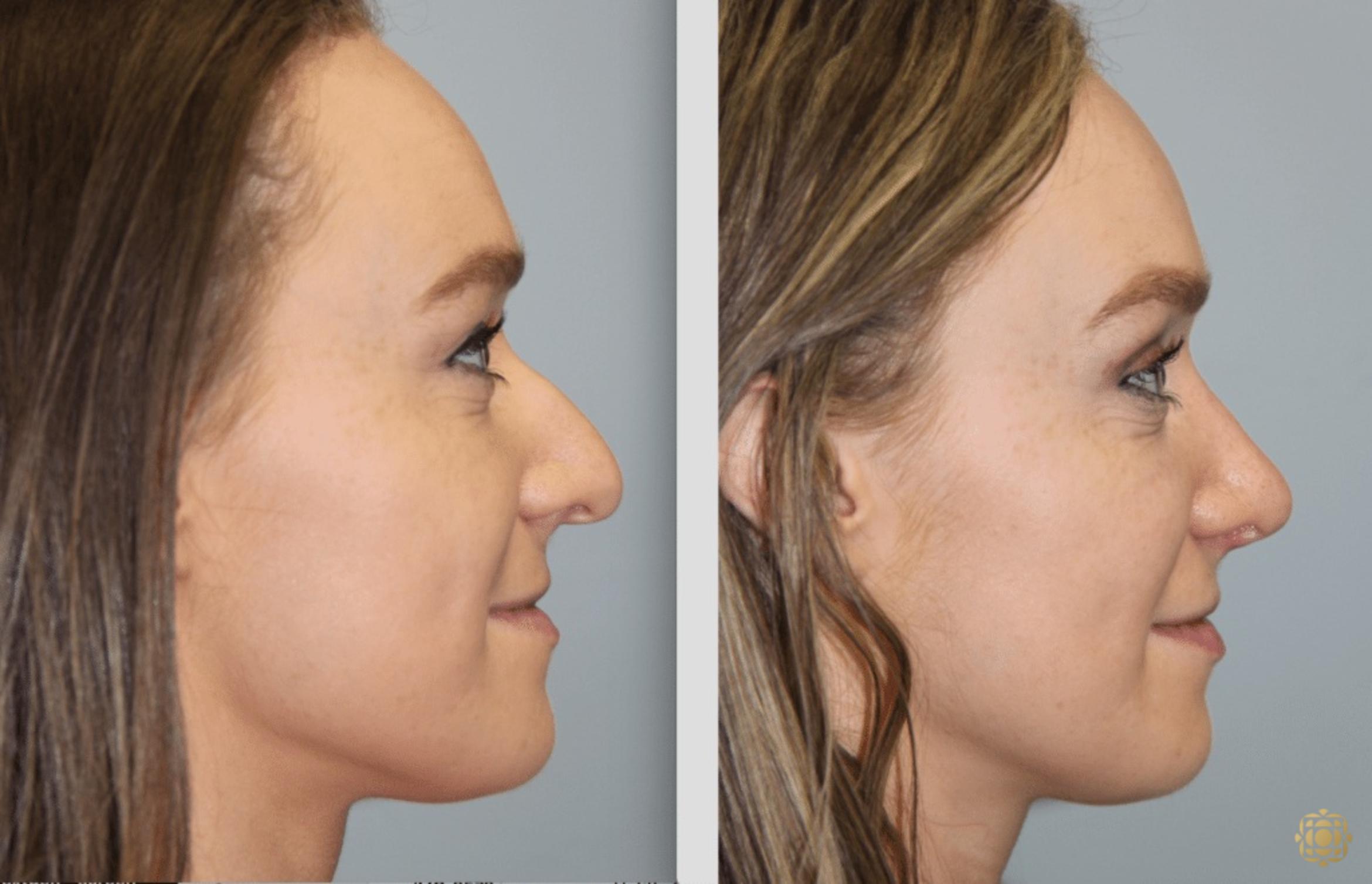 Before & After Rhinoplasty Case 117 View #4 View in Newport Beach, CA
