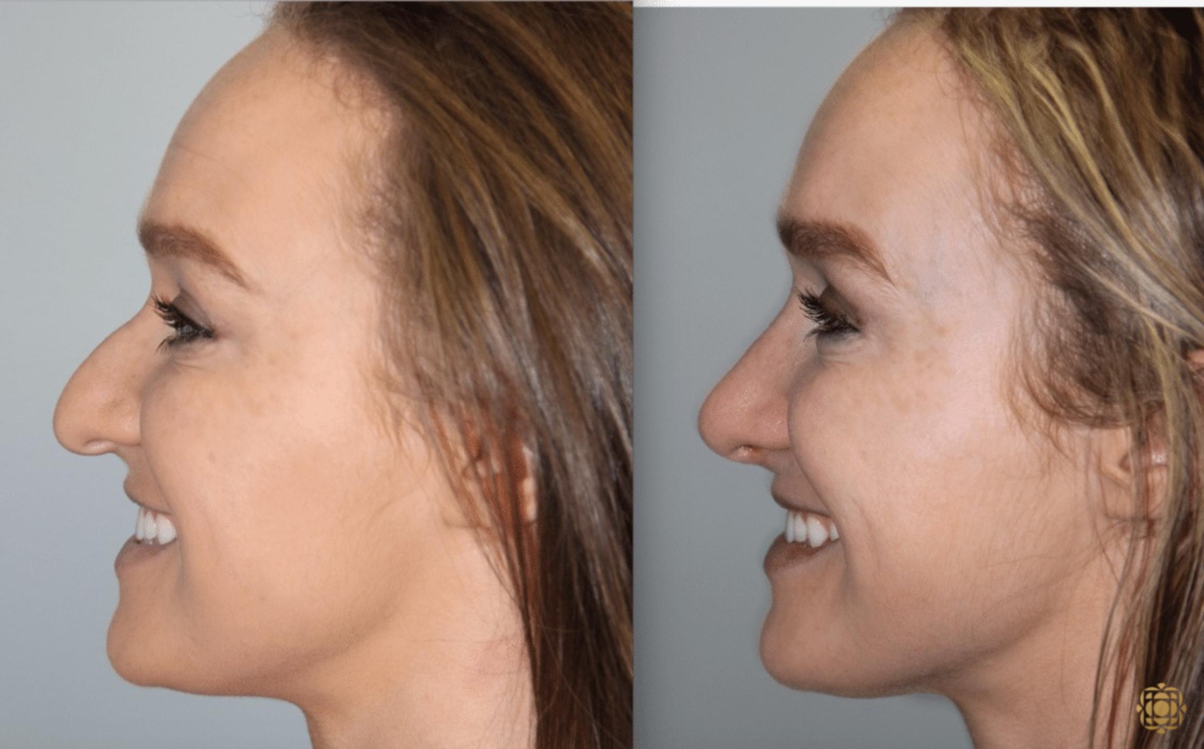 Before & After Rhinoplasty Case 117 View #5 View in Newport Beach, CA