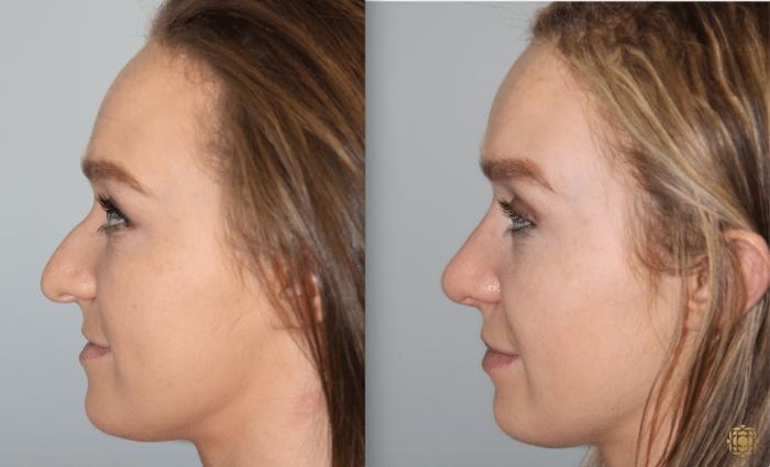 Before & After Rhinoplasty Case 117 View #6 View in Newport Beach, CA