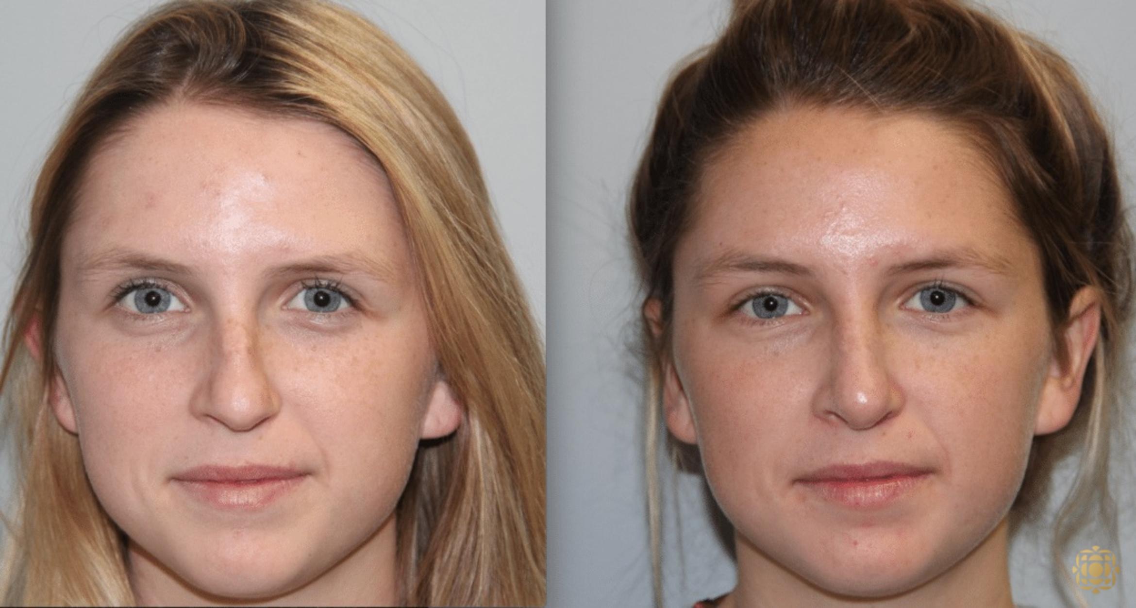 Before & After Rhinoplasty Case 120 View #1 View in Newport Beach, CA
