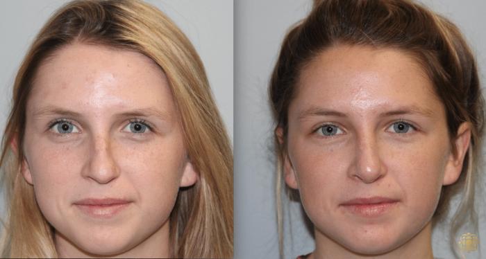 Before & After Rhinoplasty Case 120 View #1 View in Newport Beach, CA