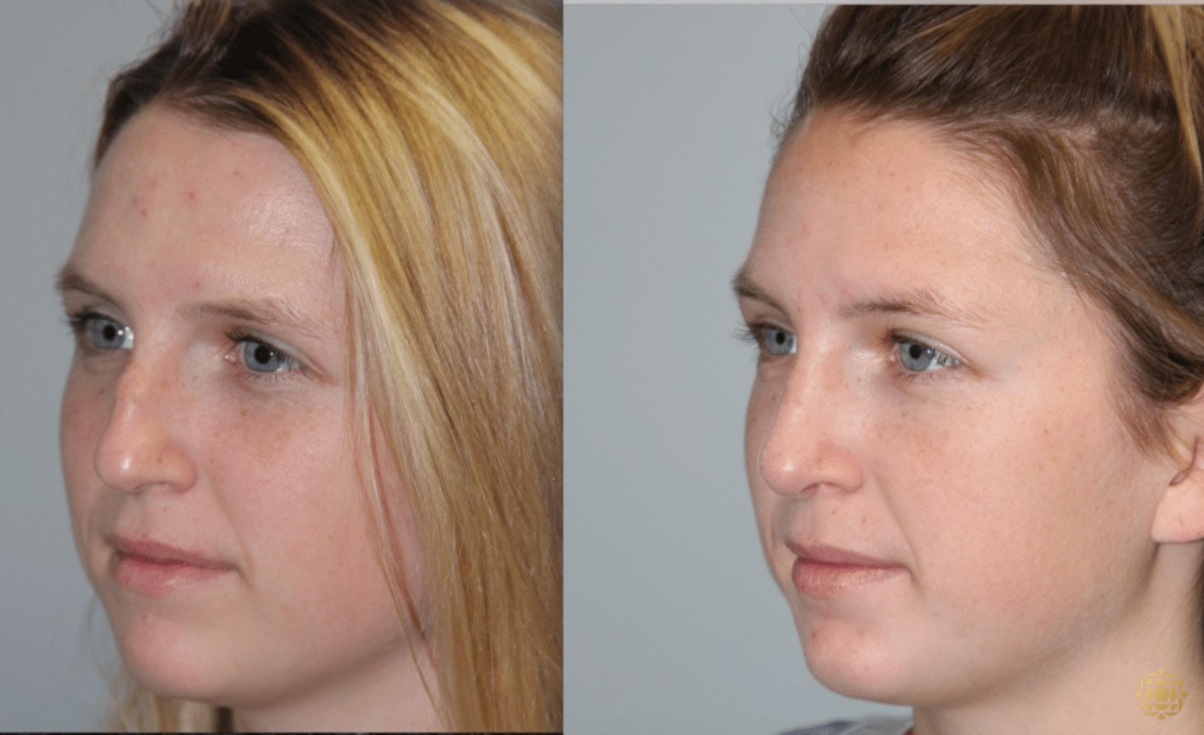 Before & After Rhinoplasty Case 120 View #2 View in Newport Beach, CA