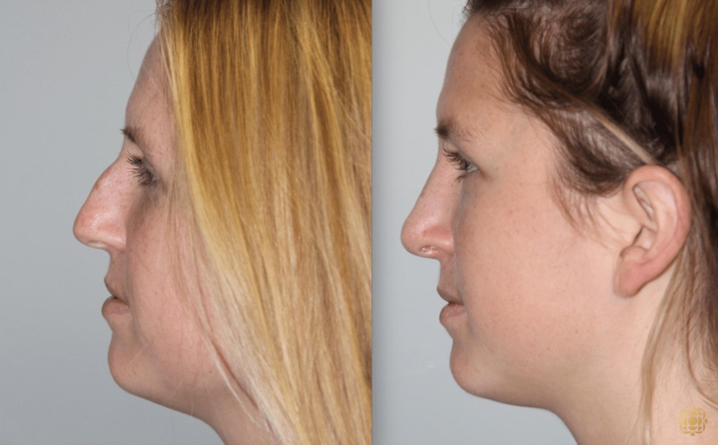 Before & After Rhinoplasty Case 120 View #3 View in Newport Beach, CA