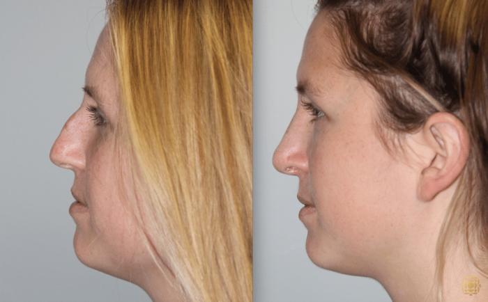 Before & After Rhinoplasty Case 120 View #3 View in Newport Beach, CA