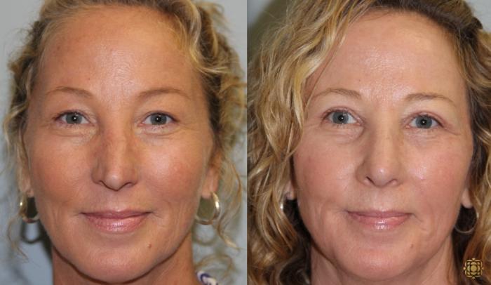 Before & After Rhinoplasty Case 122 View #1 View in Newport Beach, CA