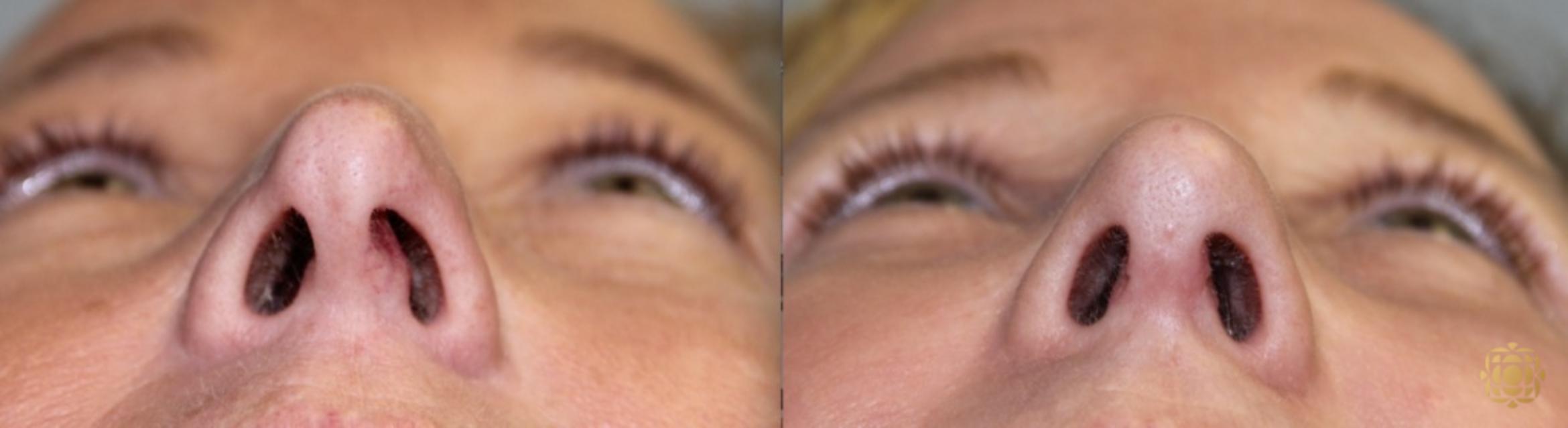 Before & After Rhinoplasty Case 122 View #2 View in Newport Beach, CA