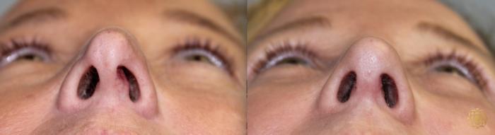 Before & After Rhinoplasty Case 122 View #2 View in Newport Beach, CA