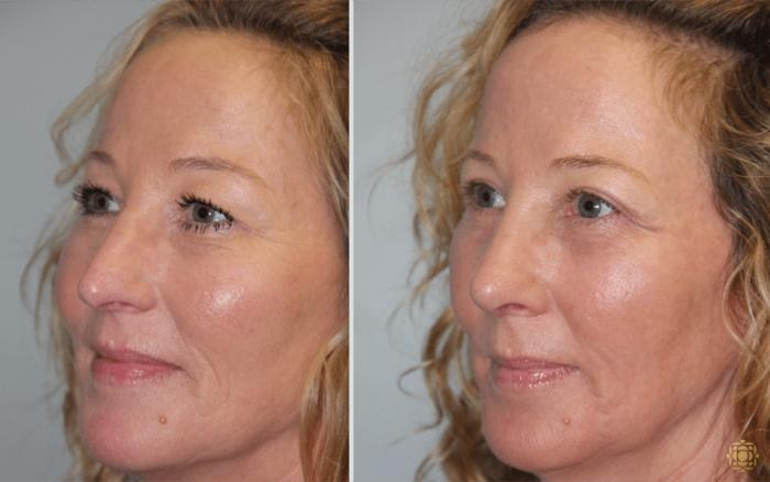 Before & After Rhinoplasty Case 122 View #3 View in Newport Beach, CA