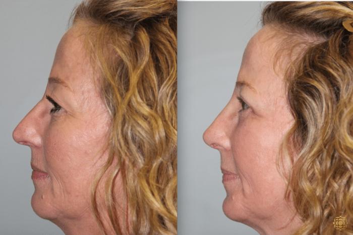 Before & After Rhinoplasty Case 122 View #4 View in Newport Beach, CA