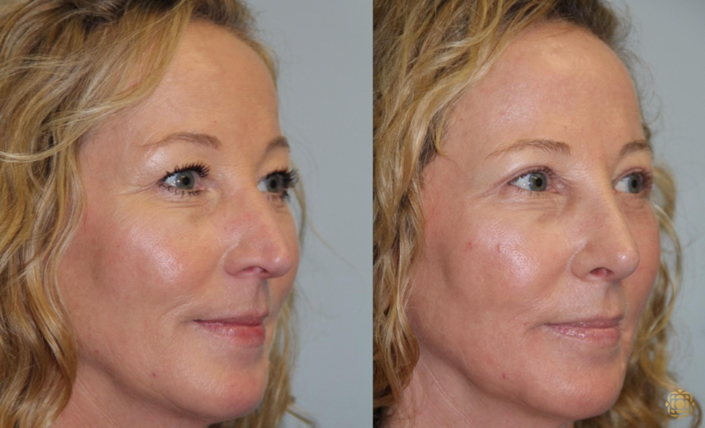 Before & After Rhinoplasty Case 122 View #5 View in Newport Beach, CA