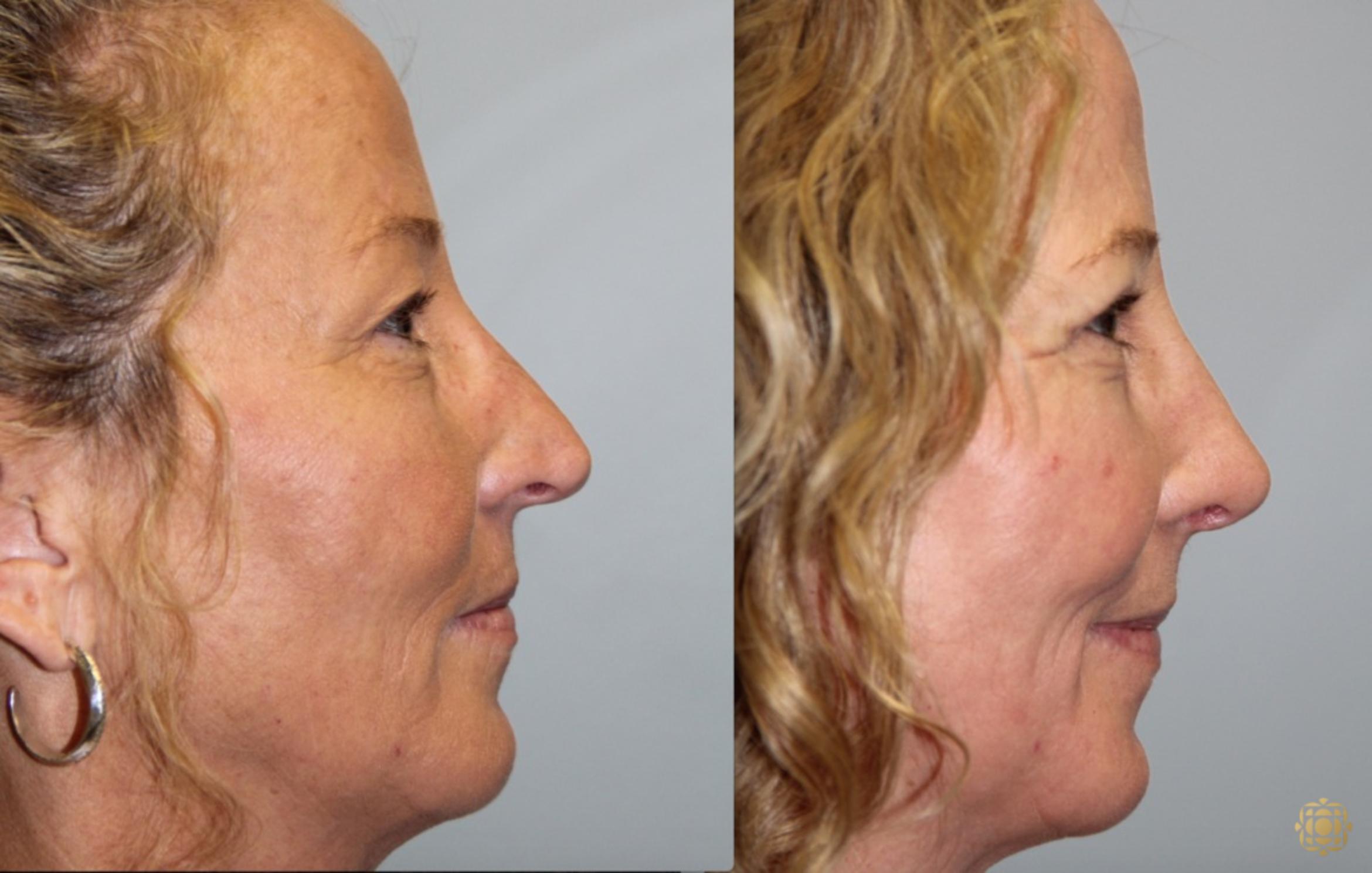 Before & After Rhinoplasty Case 122 View #6 View in Newport Beach, CA