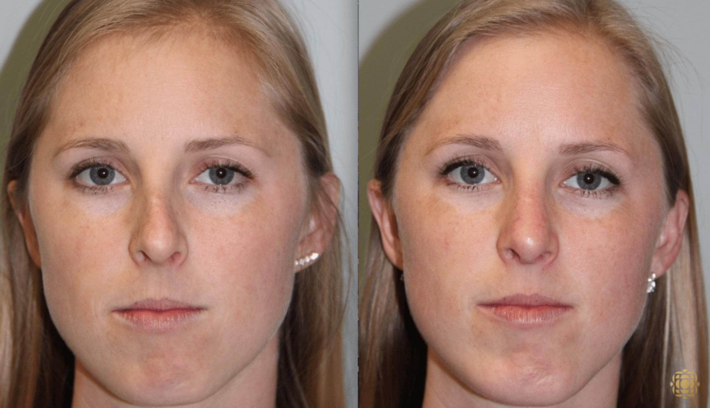 Before & After Rhinoplasty Case 123 View #1 View in Newport Beach, CA