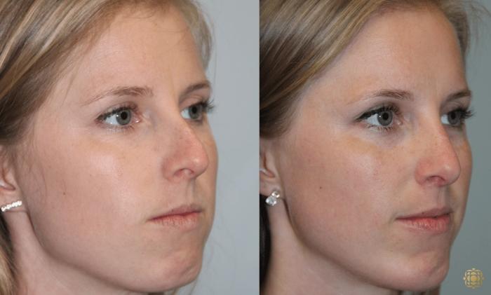 Before & After Rhinoplasty Case 123 View #2 View in Newport Beach, CA