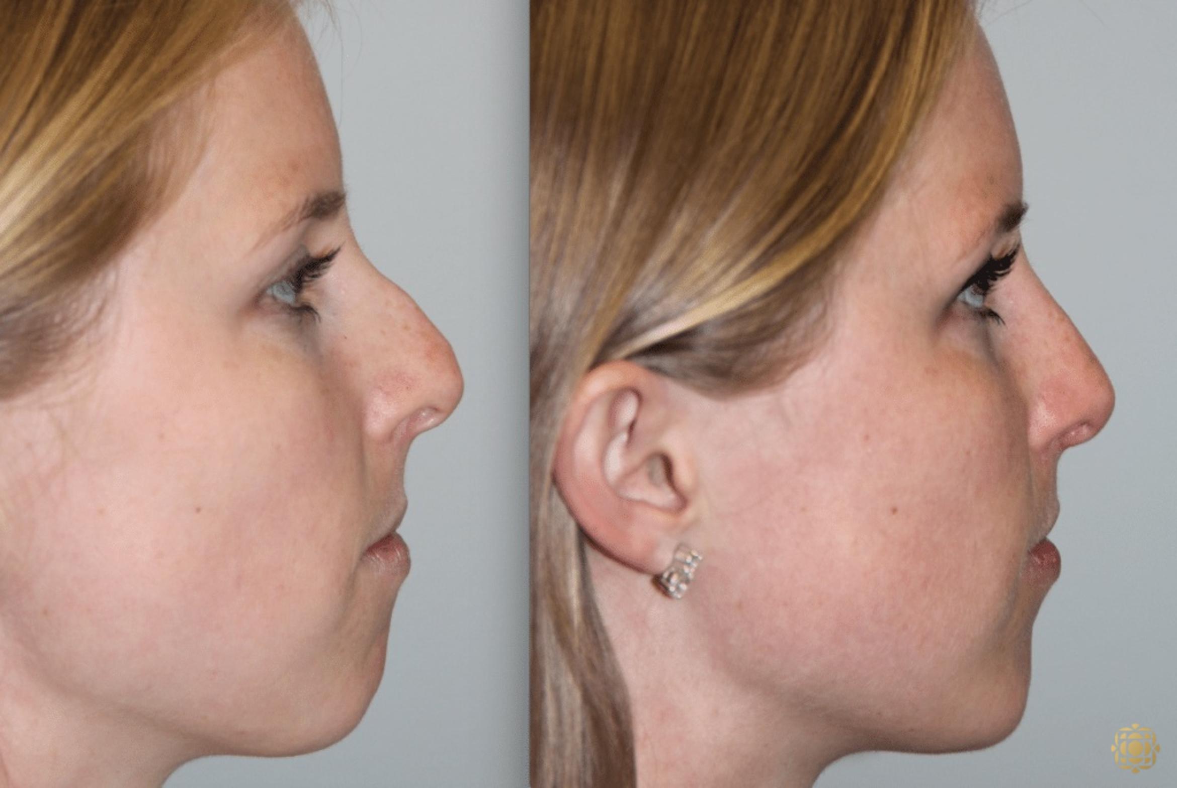 Before & After Rhinoplasty Case 123 View #3 View in Newport Beach, CA