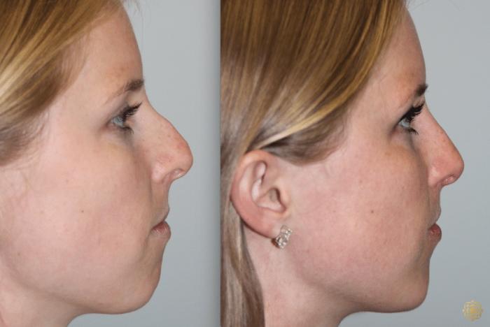 Before & After Rhinoplasty Case 123 View #3 View in Newport Beach, CA