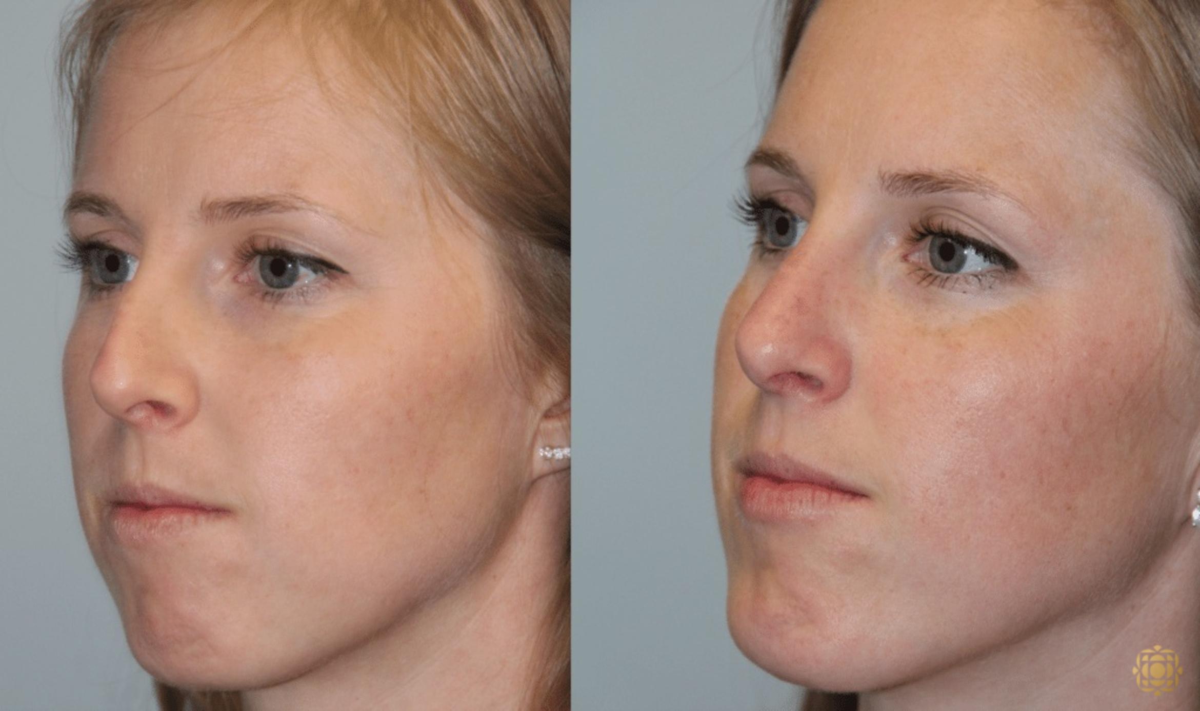 Before & After Rhinoplasty Case 123 View #4 View in Newport Beach, CA