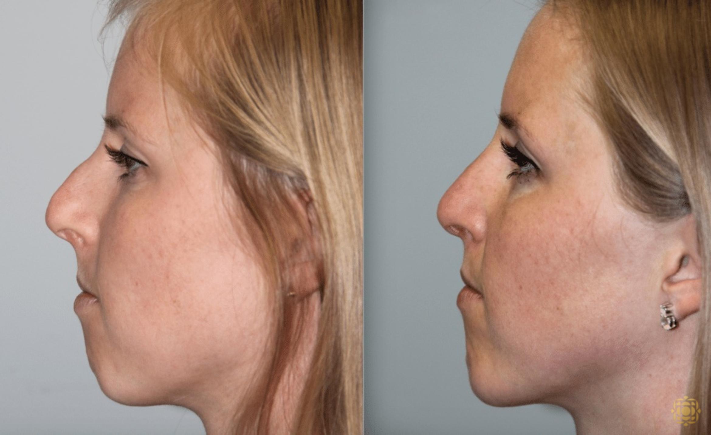 Before & After Rhinoplasty Case 123 View #5 View in Newport Beach, CA
