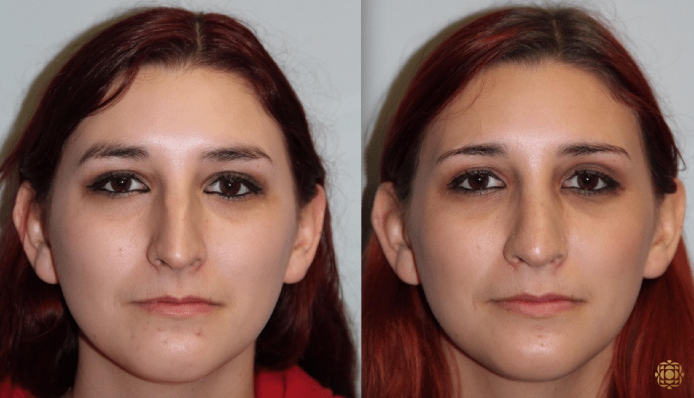 Before & After Rhinoplasty Case 124 View #1 View in Newport Beach, CA