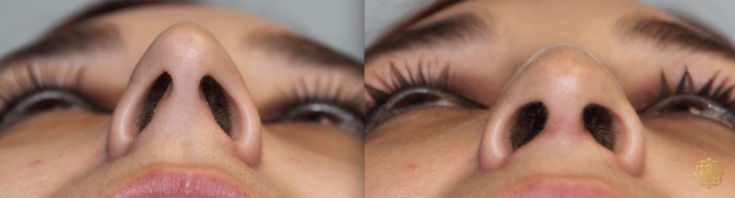 Before & After Rhinoplasty Case 124 View #2 View in Newport Beach, CA