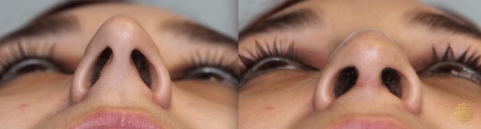 Before & After Rhinoplasty Case 124 View #2 View in Newport Beach, CA