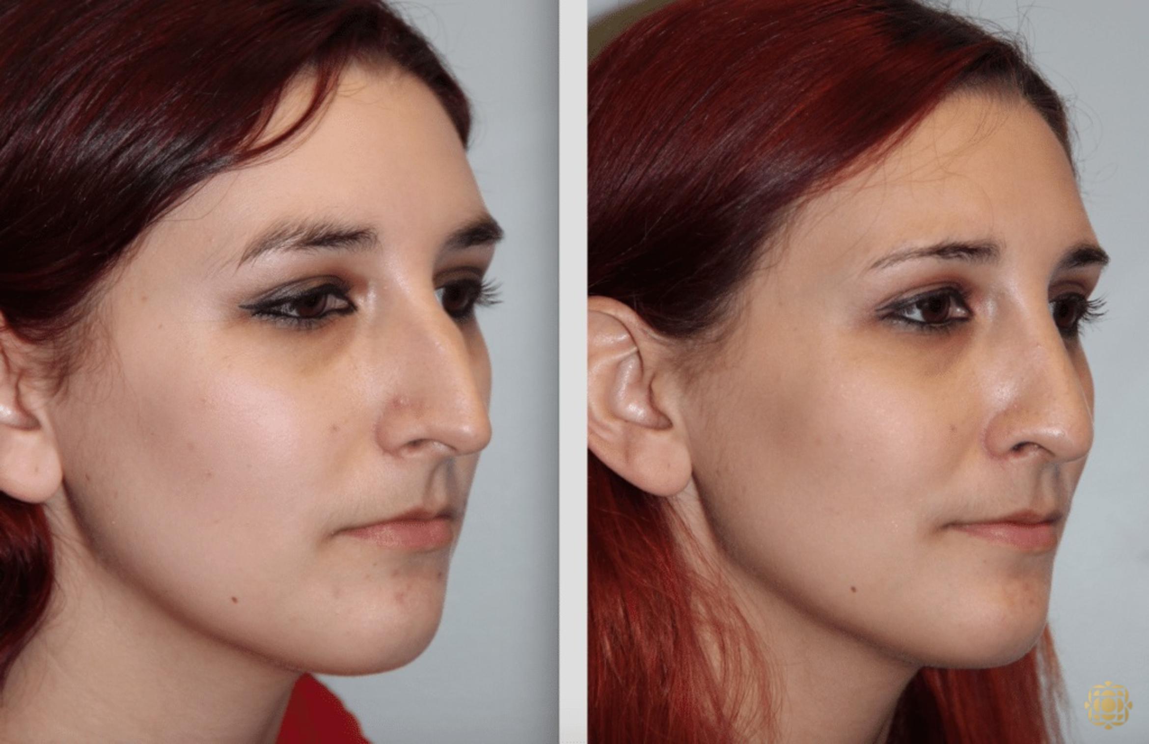 Before & After Rhinoplasty Case 124 View #3 View in Newport Beach, CA