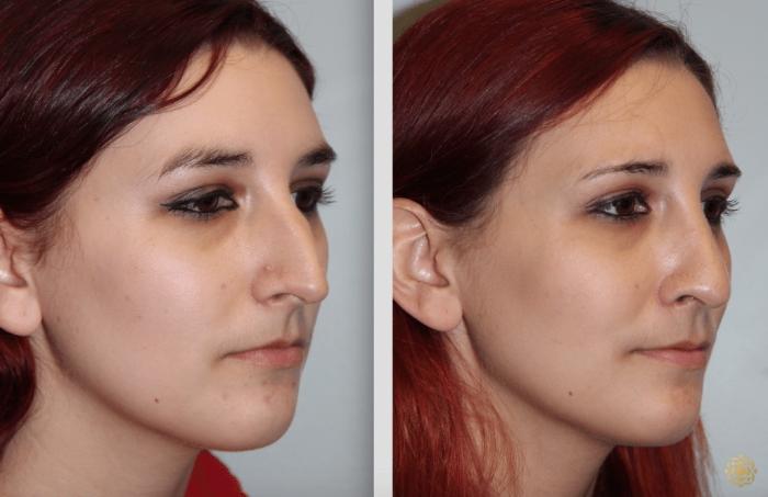 Before & After Rhinoplasty Case 124 View #3 View in Newport Beach, CA
