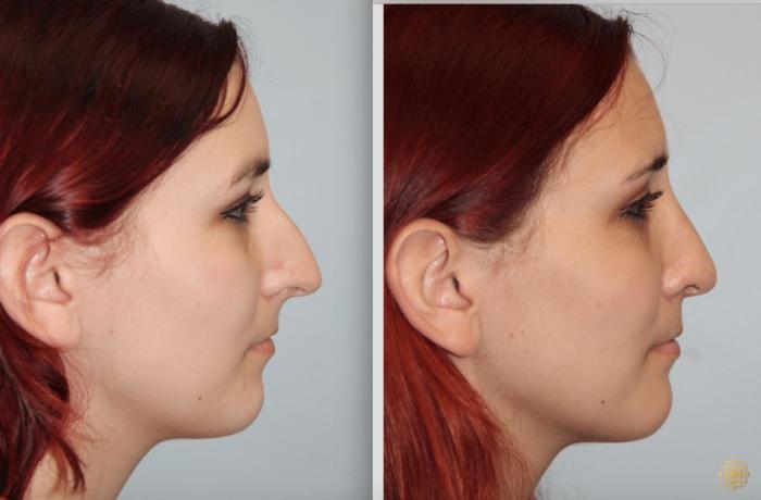 Before & After Rhinoplasty Case 124 View #4 View in Newport Beach, CA
