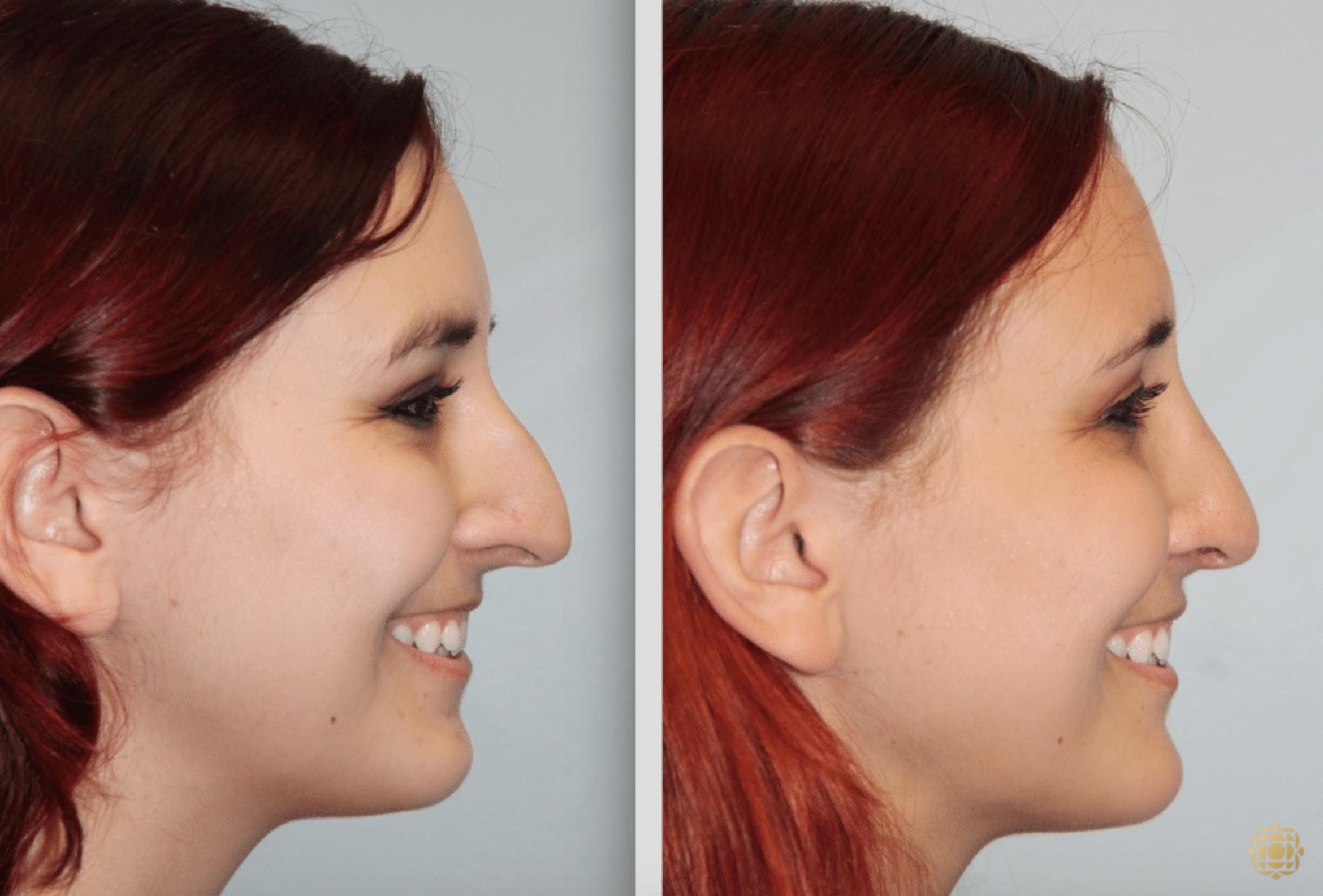 Before & After Rhinoplasty Case 124 View #5 View in Newport Beach, CA