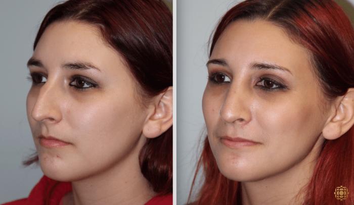 Before & After Rhinoplasty Case 124 View #6 View in Newport Beach, CA