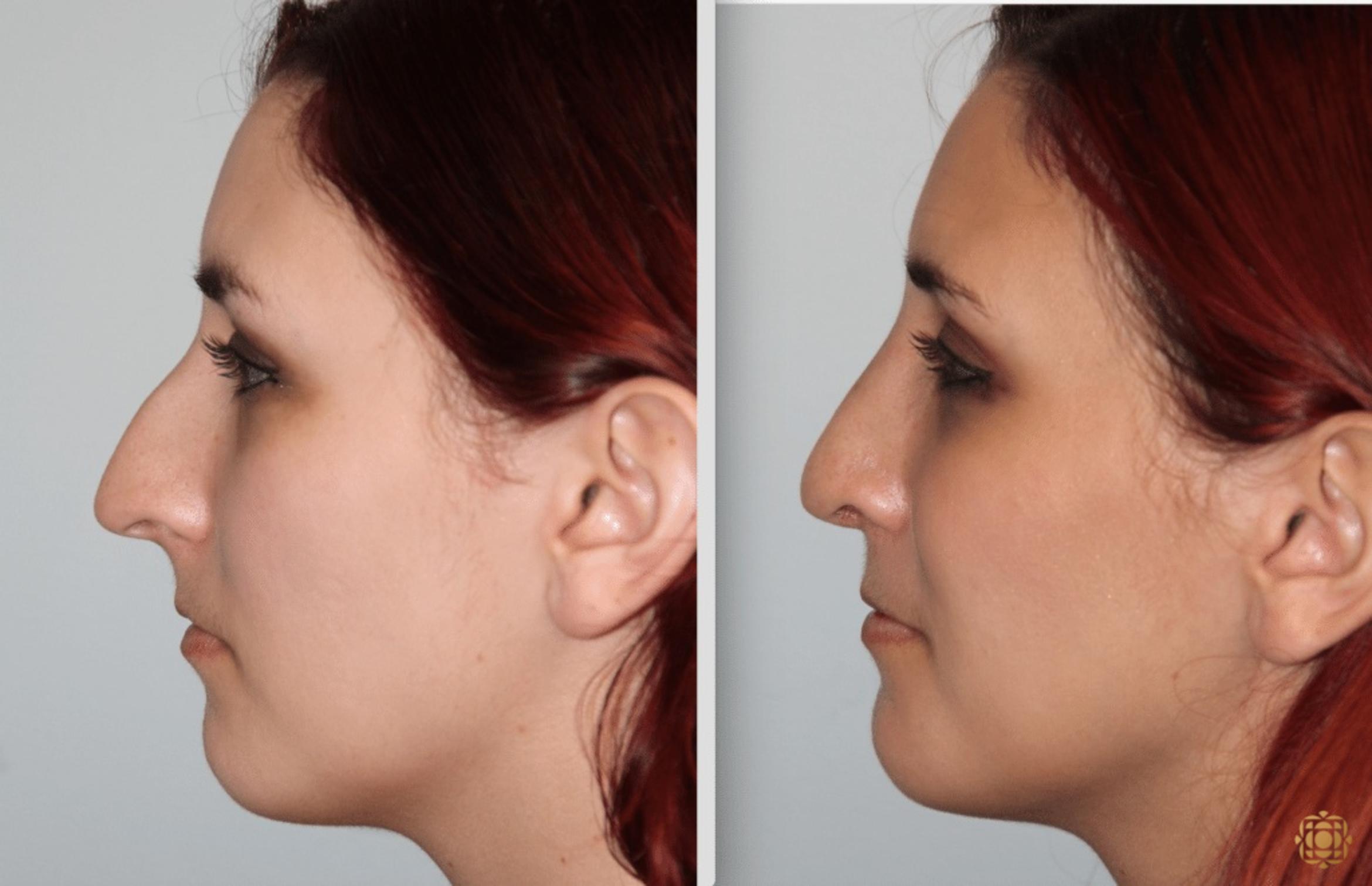Before & After Rhinoplasty Case 124 View #7 View in Newport Beach, CA