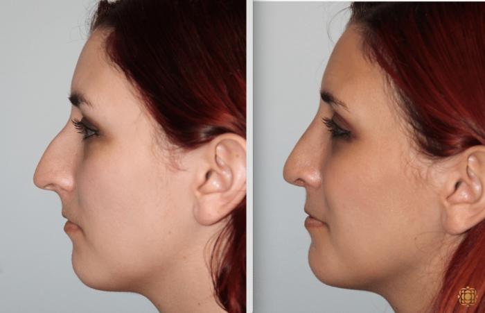 Before & After Rhinoplasty Case 124 View #7 View in Newport Beach, CA