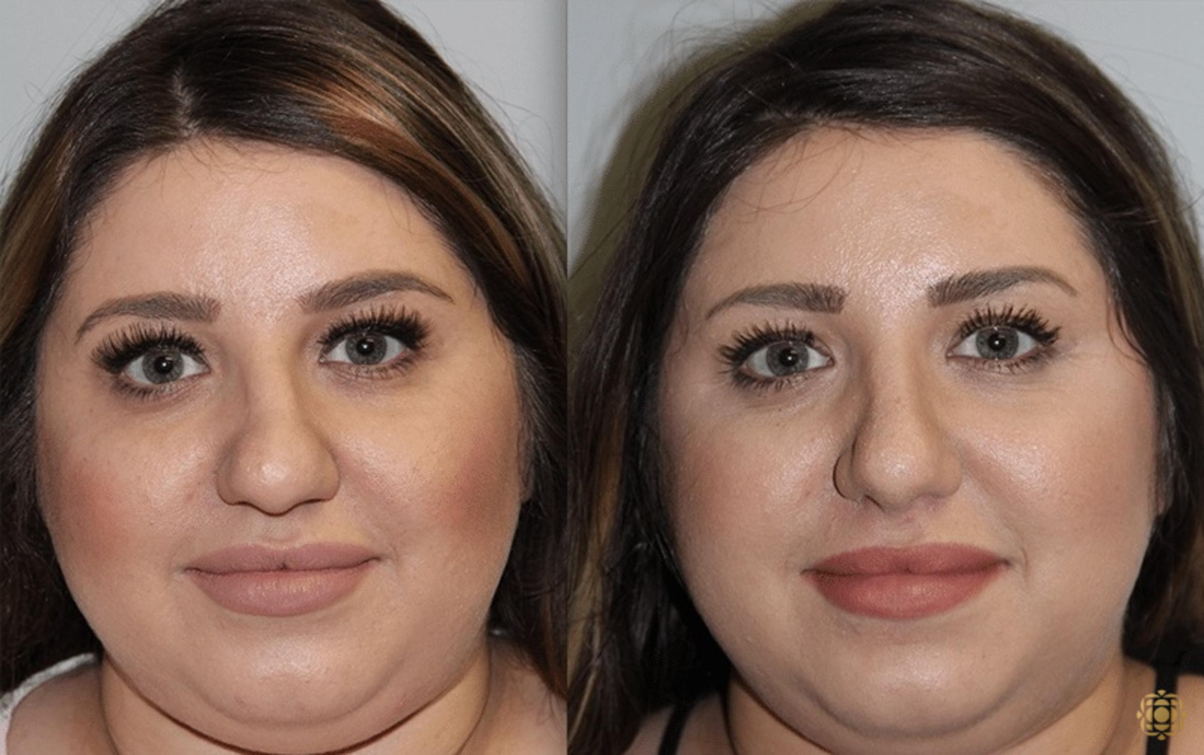Before & After Rhinoplasty Case 125 Front View in Newport Beach, CA