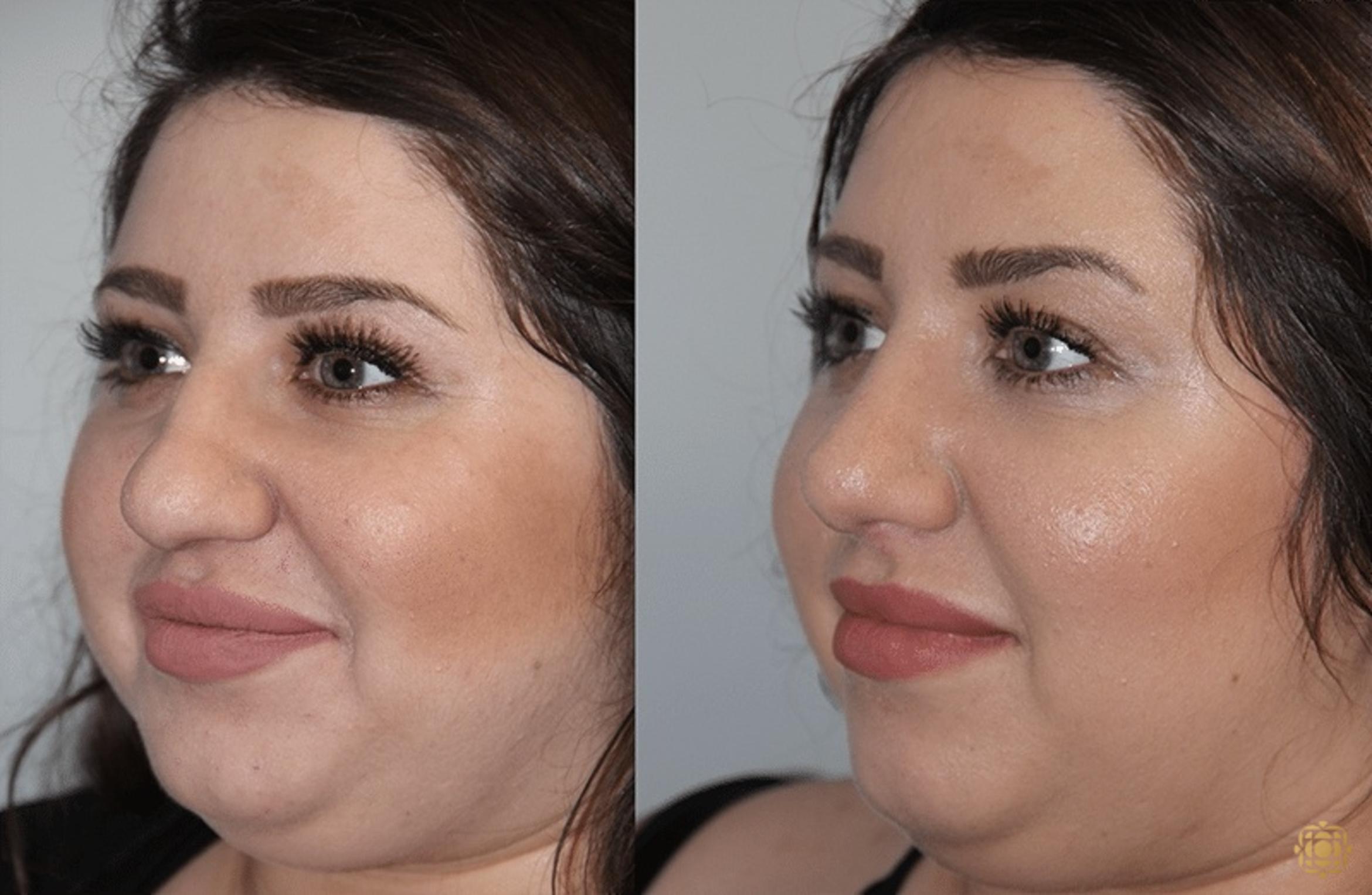 Before & After Rhinoplasty Case 125 Left Oblique View in Newport Beach, CA