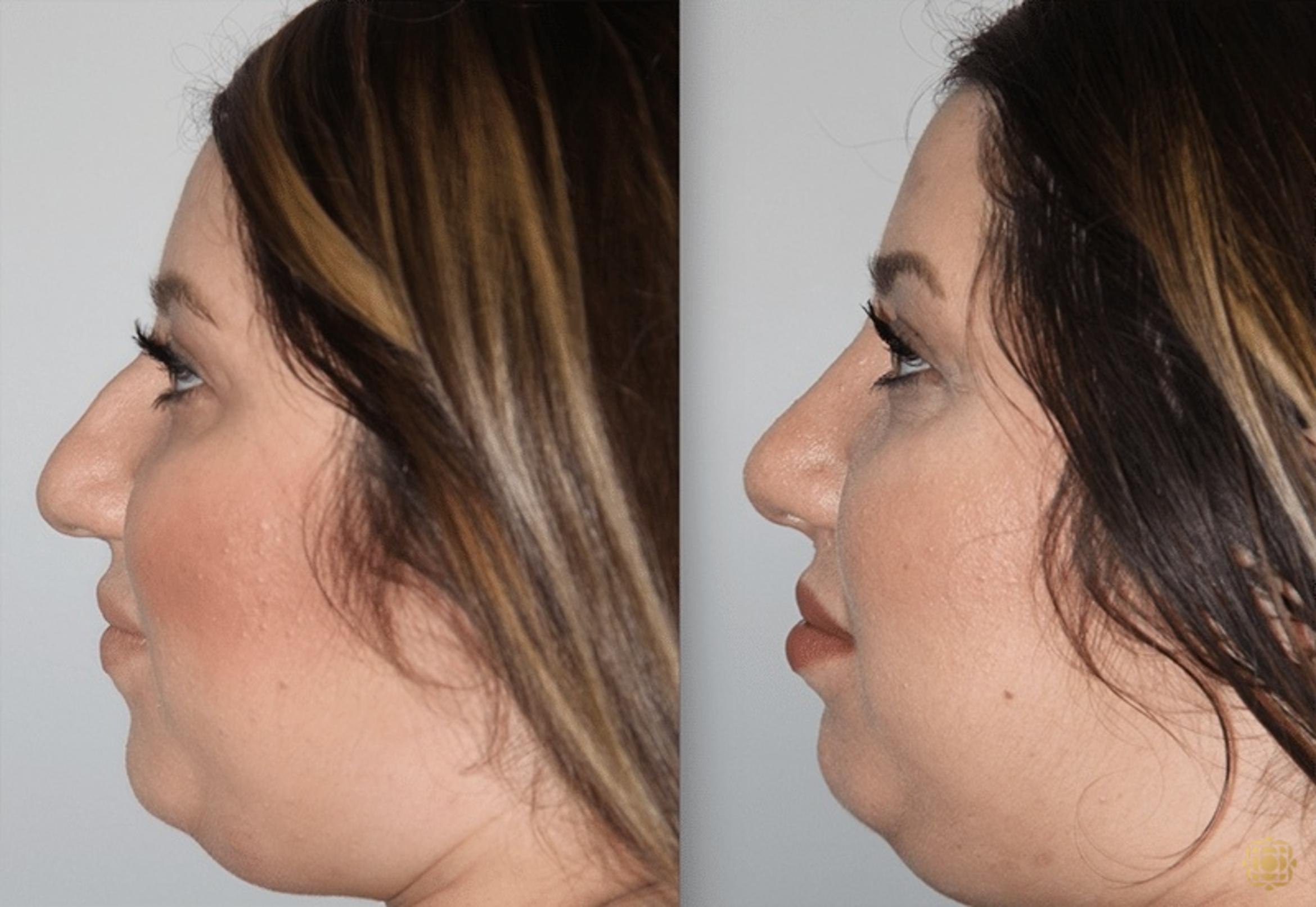 Before & After Rhinoplasty Case 125 Left Side View in Newport Beach, CA