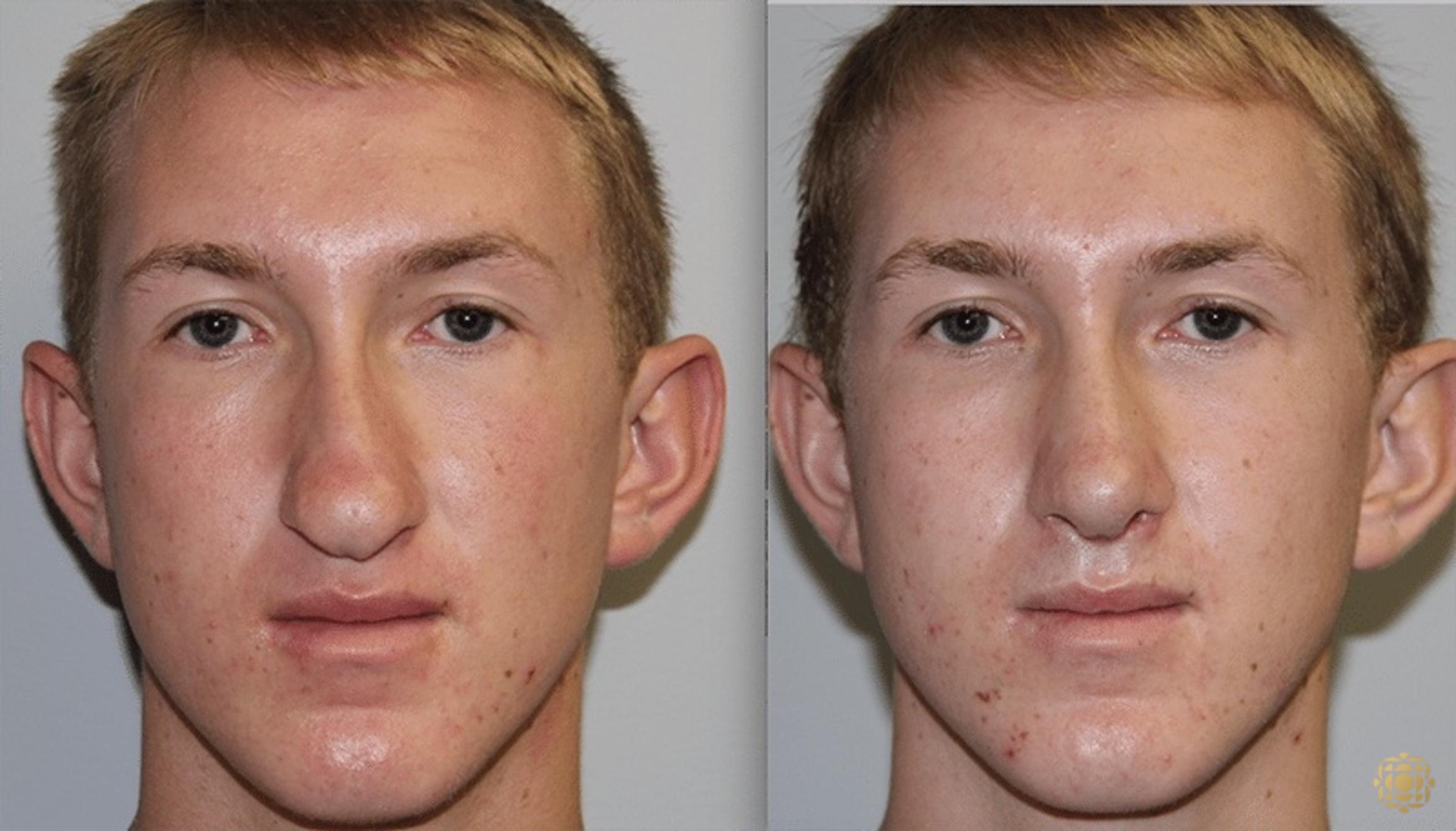 Before & After Rhinoplasty Case 133 Front View in Newport Beach, CA